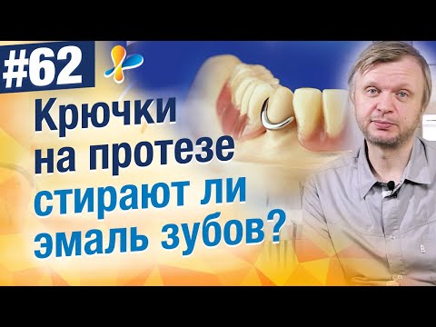 Видео: Стирают ли эмаль зубов крючки на протезе (кламмера)?