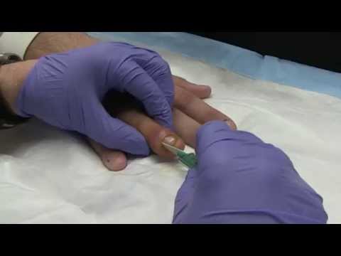 Видео: Лечение паронихии