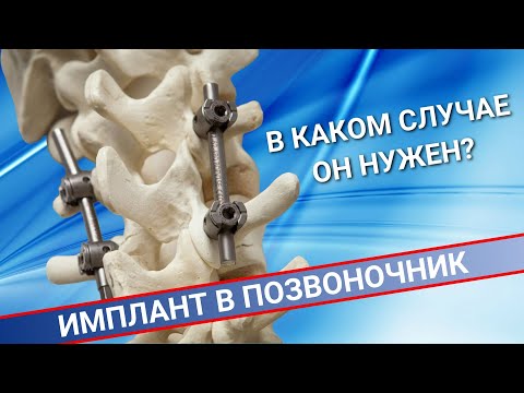 Видео: НУЖНО ЛИ СТАВИТЬ ИМПЛАНТ В ПОЗВОНОЧНИК?