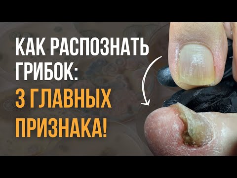 Видео: 3 главных признака грибка!