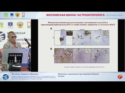 Видео: Ильченко Людмила Юрьевна Фенотипы саркопении при жировой болезни печени
