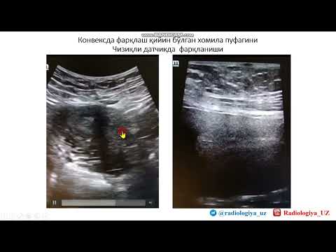 Видео: Эрта муддатли ҳомиладорликни аниқлашда алтернатив ёндашув (чизиқли датчик) - Dr.Lapasov Hasan