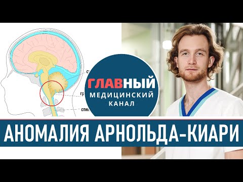 Видео: Симптомы Аномалии Арнольда-Киари. Синдром Арнольда Киари 1-2 типа/степени. Эктопия миндалин мозжечка
