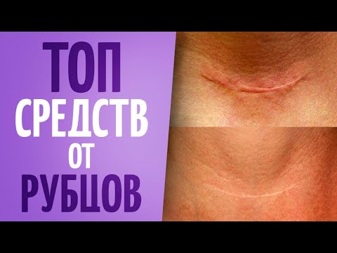 Видео: ТОП средств от рубцов и шрамов