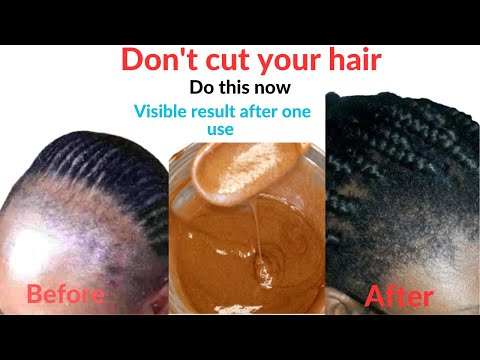 Видео: ВАУ! РАБОТАЕТ😱. НЕ СТРИГАЙТЕ ВОЛОСЫ. Как я восстановила потерянную линию роста волос за 2 недели.