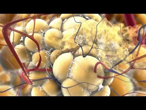 Видео: Лазерный липолиз