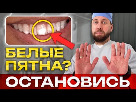 Видео: Белые пятна на зубах — признак беды? Срочно нужно проверить это...