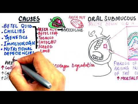 Видео: Подслизистый фиброз полости рта: причины, гистопатология, эпидемиология и лечение