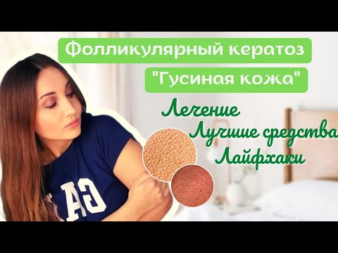 Видео: 🦆ГУСИНАЯ КОЖА: Как избавиться?ФОЛЛИКУЛЯРНЫЙ ГИПЕРКЕРАТОЗ на руках, ногах,лице, попе: Фото, Лечение.