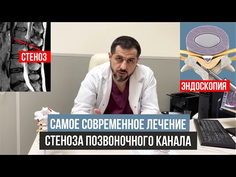Видео: Стеноз позвоночного канала поясничного отдела | Cимптомы и лечение.