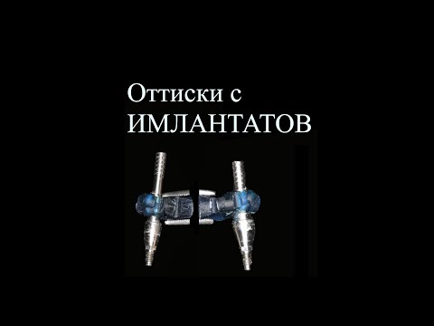Видео: Оттиски (слепки) с имплантатов. Имплантат, формирователь, аналог и т.д. The impression with implant