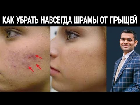Видео: Следы От Прыщей Затягиваются Очень Быстро?