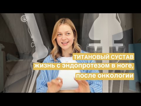 Видео: Жизнь после онкологии с эндопротезом в ноге. Осложнения | Восстановление | Беременность