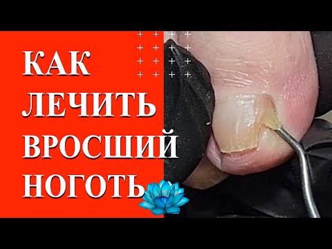 Видео: Вросший ноготь лечение тампонадой.