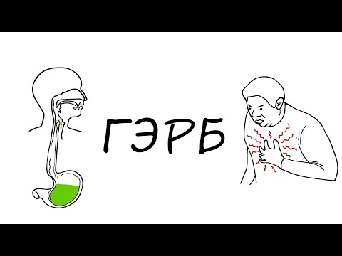 Видео: Гастроэзофагеальная рефлюксная болезнь / ГЭРБ