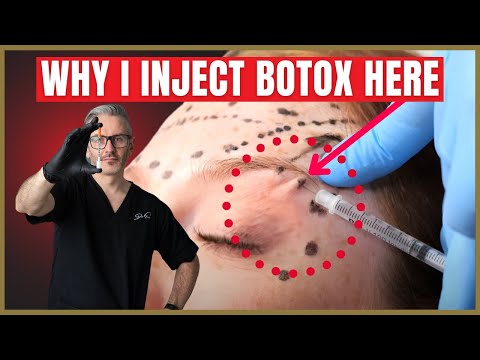 Видео: Как колоть ботокс под бровь | Советы по подтяжке бровей с помощью ботокса