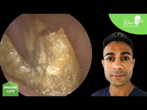 Видео: 1,278 - x3 видео об удалении ушной серы