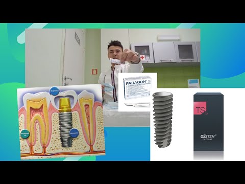 Видео: имплантация для ассистентов