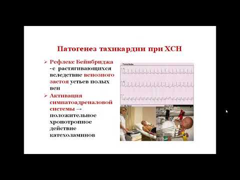 Видео: Хроническая сердечная недостаточность у детей
