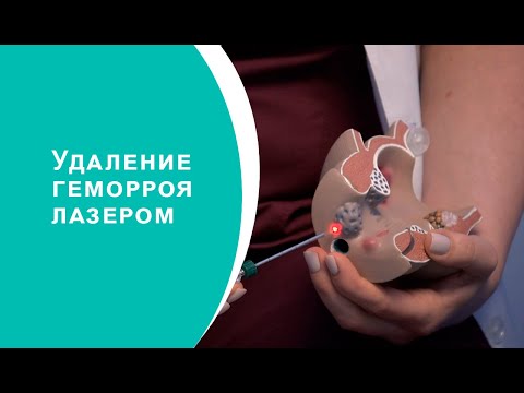 Видео: Удаление геморроя лазером