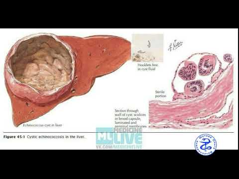 Видео: Эхинококкоз