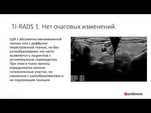 Видео: ИСПОЛЬЗОВАНИЕ TI-RADS (ТИРАДС) В ПРАКТИКЕ ВРАЧА УЛЬТРАЗВУКОВОЙ ДИАГНОСТИКИ. Часть 1.