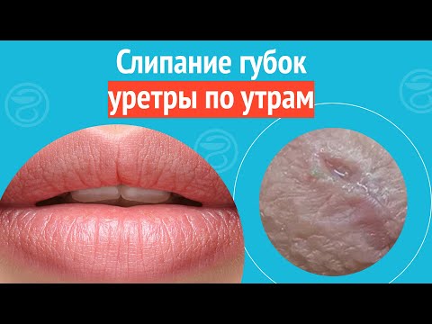 Видео: 🥺 Слипание губок уретры по утрам. Клинический случай №1289