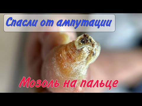 Видео: Страшная мозоль на пальце/ как убрать мозоль /ампутация пальца