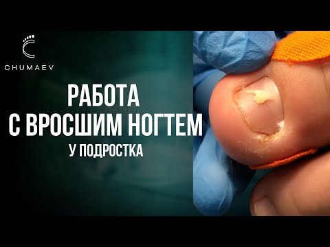 Видео: Работа с вросшим ногтем #вросшийноготь