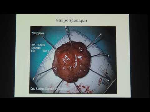 Видео: КС04 Дыленок АА   Случай удаления раннего рака желудка методикой полностенной резекции с лапароскопи