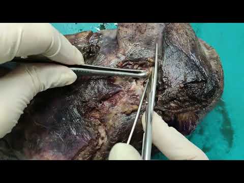 Видео: Макроскопическое исследование опухолей легкого  Периферический рак