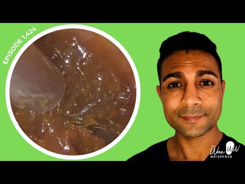 Видео: 1424 — Пациент расчувствовался и расплакался во время удаления ушной серы