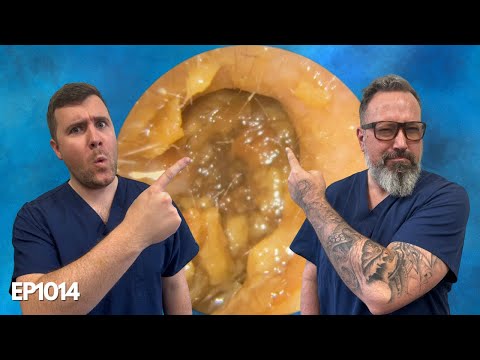 Видео: Удаление ушной серы в США - EP1014