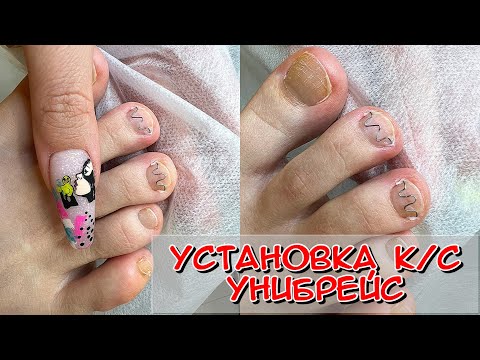 Видео: Установка Унибрейс