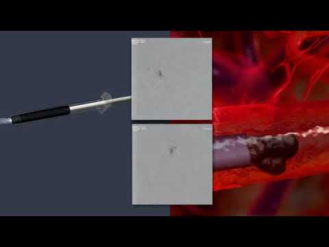 Видео: Эмболизация Артериовенозной мальформация с ONYX