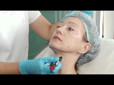 Видео: Как делают ботокс в клинике
