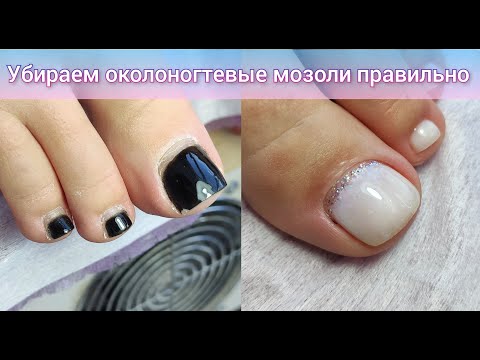 Видео: ПОЧЕМУ БОЛЯТ НОГТИ. КАК ПРАВИЛЬНО УБРАТЬ ПОДНОГТЕВЫЕ МОЗОЛИ. NAIL PAIN. PEDICURE/ 修腳 / 腳趾甲 / 修指甲