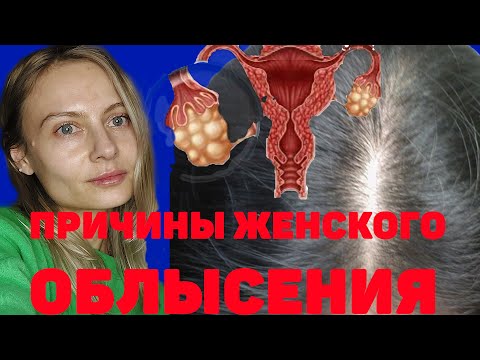 Видео: Женское облысение. Как определить причины. Виды андрогенной алопеции. Лечение.