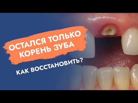 Видео: Остался только корень зуба. Как восстановить?