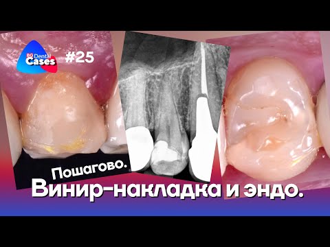 Видео: Винир-накладка и эндо. Пошагово | Дентал Кейсы от BG #25