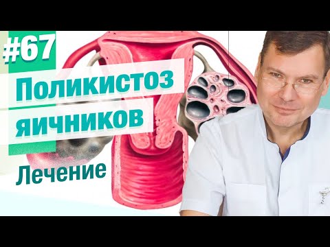 Видео: Как лечат поликистоз яичников?