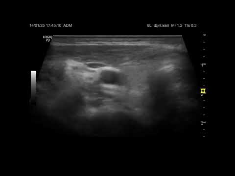 Видео: УЗИ. Доктор Иогансен. Видеопримеры. Выпуск 116. Методика УЗИ щитовидной железы (2).