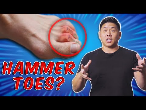 Видео: Лечение молоткообразных и когтеобразных пальцев на дому! Физиотерапевт проводит занятия