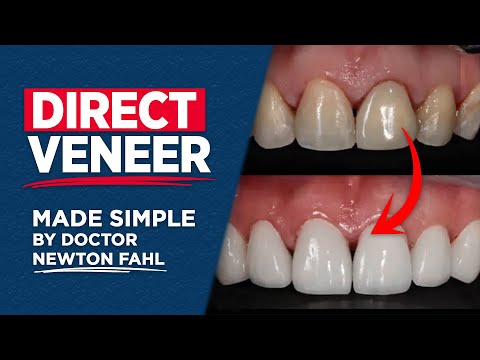 Видео: Простота установки прямых виниров от доктора Ньютона Фаль — композитная реставрация