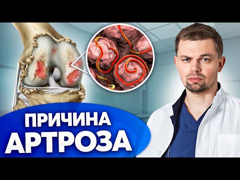 Видео: Скрытые причины боли! Как ПАРАЗИТЫ влияют на суставы?