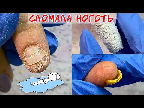 Видео: Сломала ноготь под корень / Травматический онихолизис