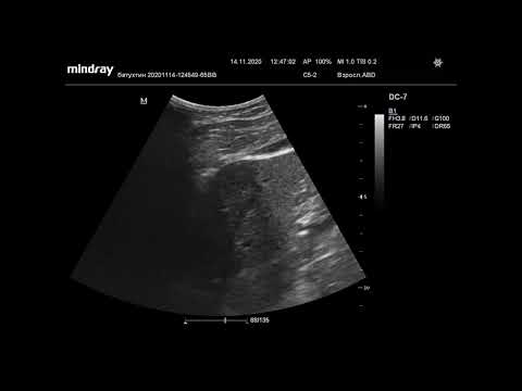Видео: Ультразвуковая диагностика (УЗИ). Доктор Иогансен. Видеопримеры. Выпуск 4. Опухоли печени.