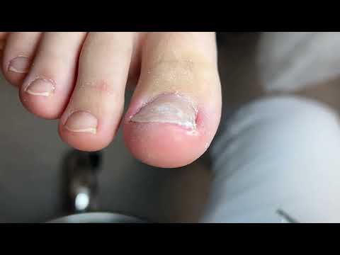 Видео: Вросший ноготь у подростка | Коррекция системы ЗТО