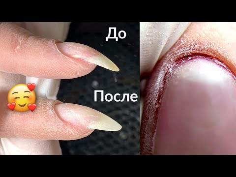 Видео: Как Исправить Загнутые ногти | Маникюр с порезами 😧