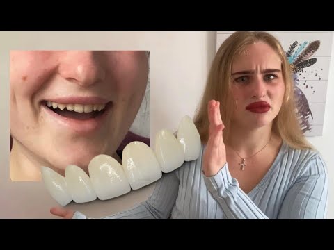 Видео: ВИНИРЫ | ДО/ПОСЛЕ | ВПЕЧАТЛЕНИЯ | ЭТАПЫ |  ИСТОРИЯ МОИХ ЗУБОВ